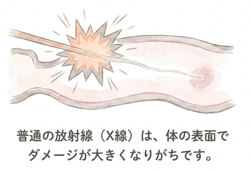 普通の放射線治療は、体の表面でダメージが大きくなりがち